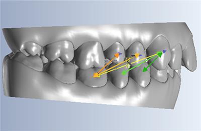 Orthodontic elastic clearance configurations